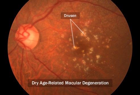 Dry Age-Related Macular Degeneration