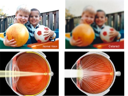 Normal Vision vs Cataract Vision